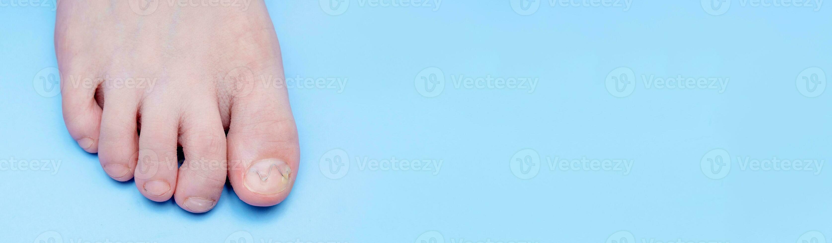 Banner Unibrace system on the leg of a teenager in the treatment of an ingrown nail, On a blue background. Toenail Correction System photo