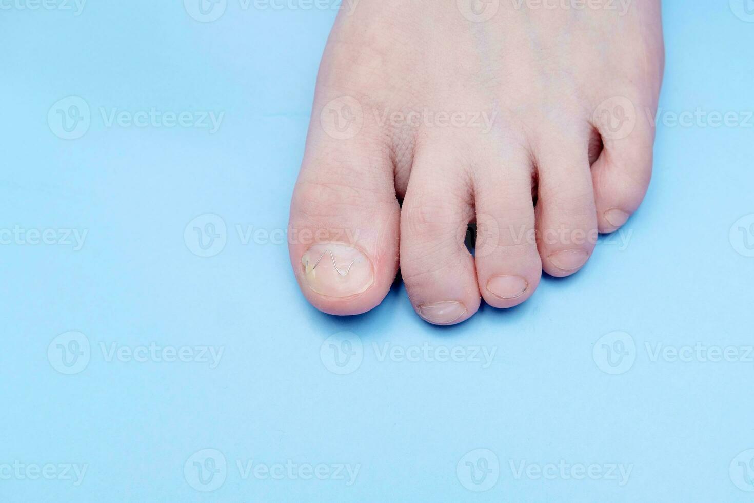 Unibrace system on the leg of a teenager in the treatment of an ingrown nail, On a blue background. Toenail Correction System photo