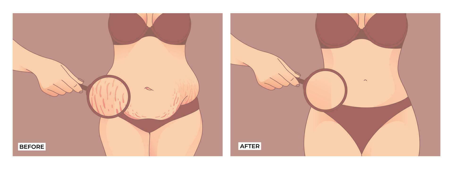 Belly fat. Before and after weight loss, woman body shape transformation, Fat To Fit. vector