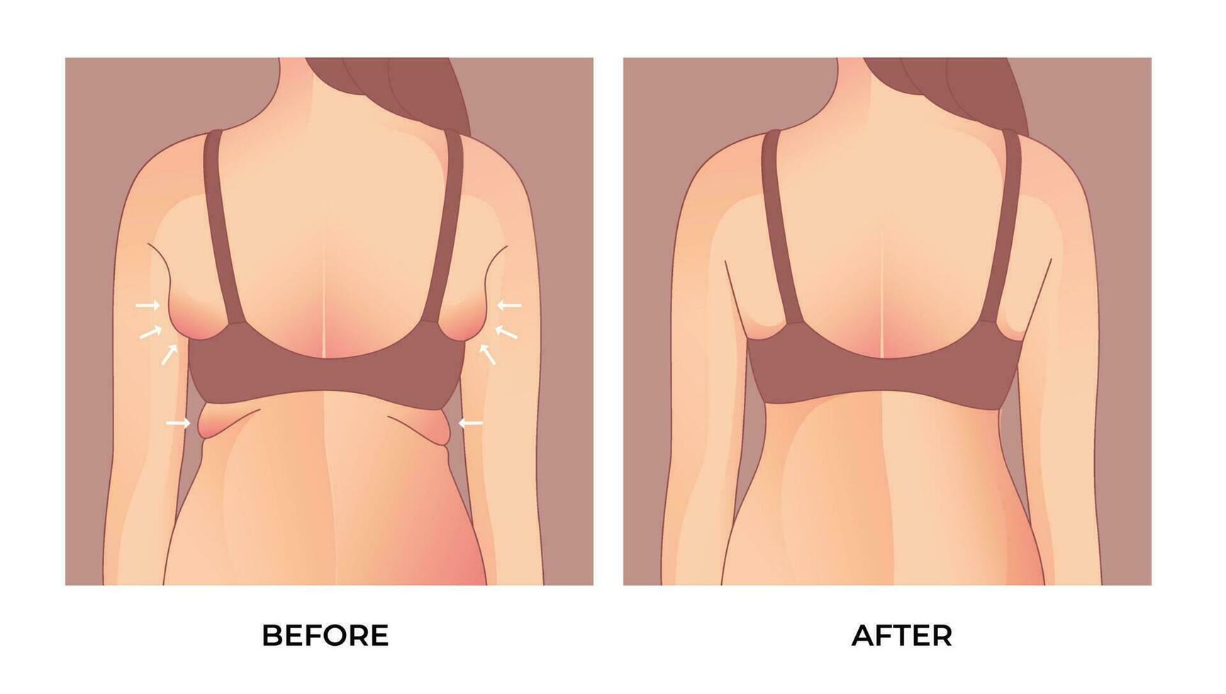 Armpit fat before and after Brachioplasty, liposuction or plastic surgery, woman body shape transformation, Fat To Fit. vector
