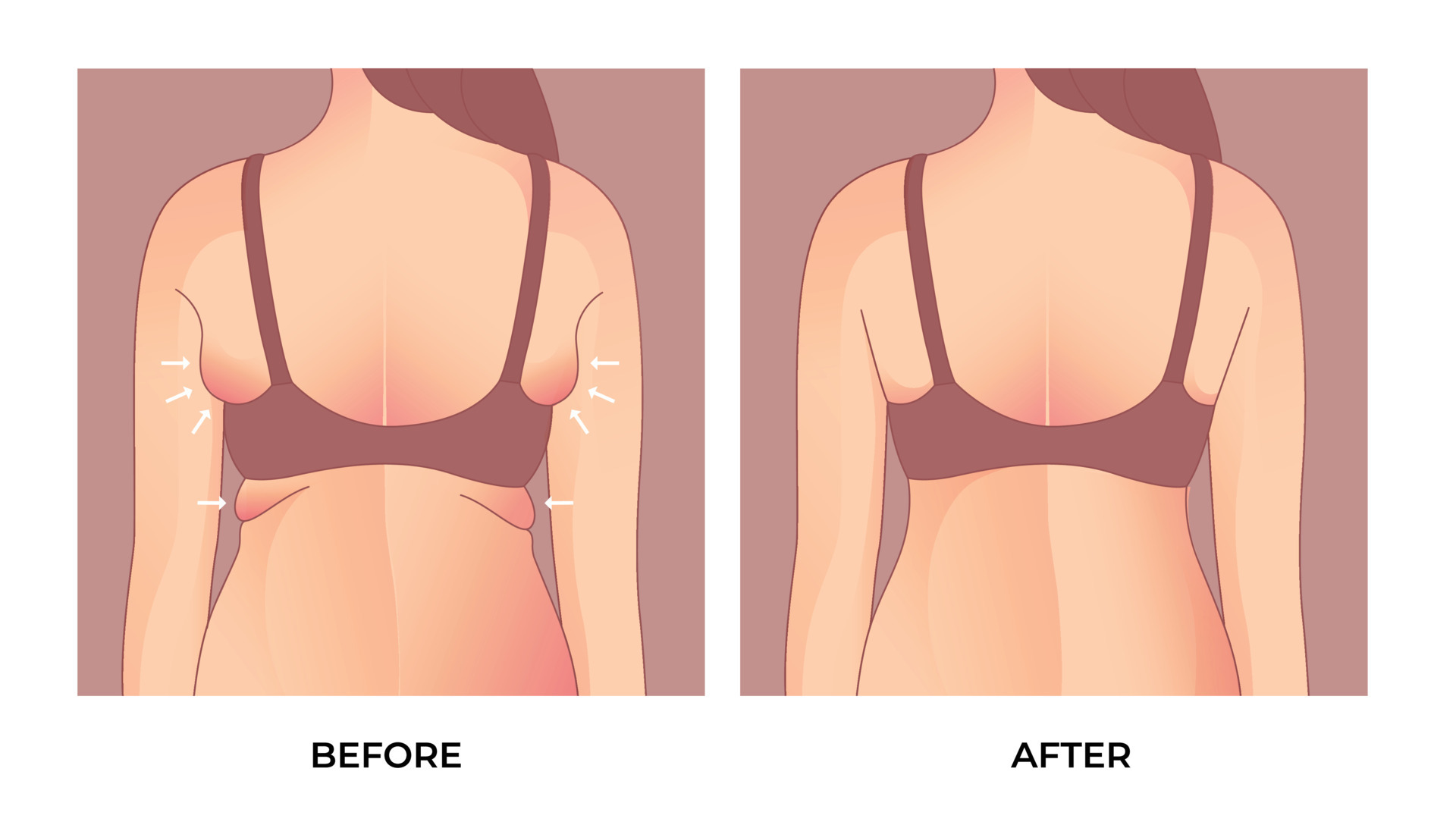 Armpit fat before and after Brachioplasty, liposuction or plastic surgery,  woman body shape transformation, Fat To Fit. 26260591 Vector Art at Vecteezy