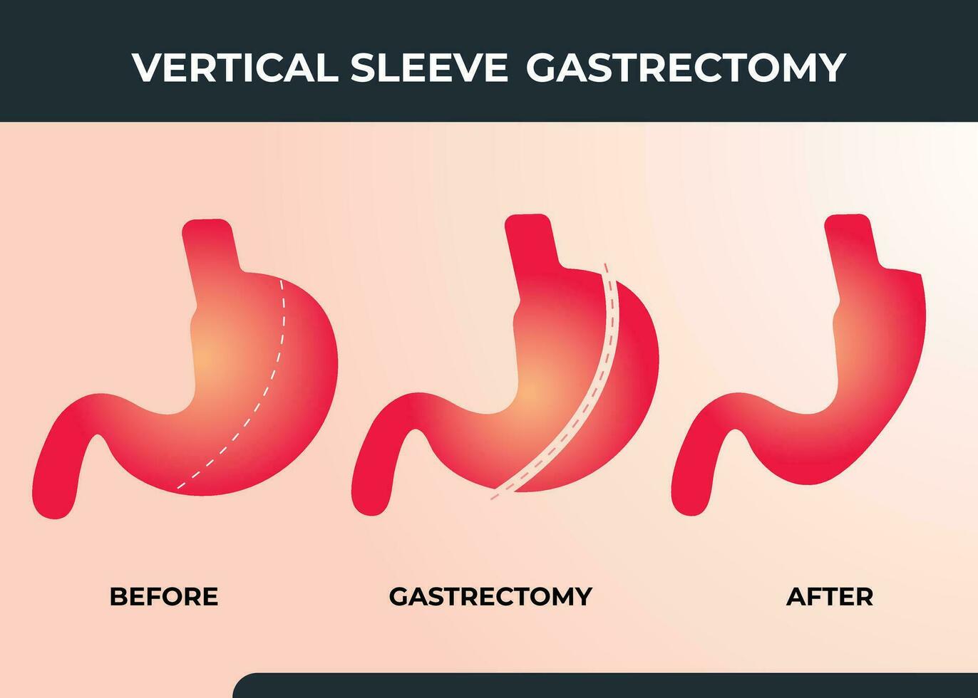 Laparoscopic Sleeve Gastrectomy, Vertical Gastrectomy, Weight loss surgery Vector Illustration of Stomach reduction surgery