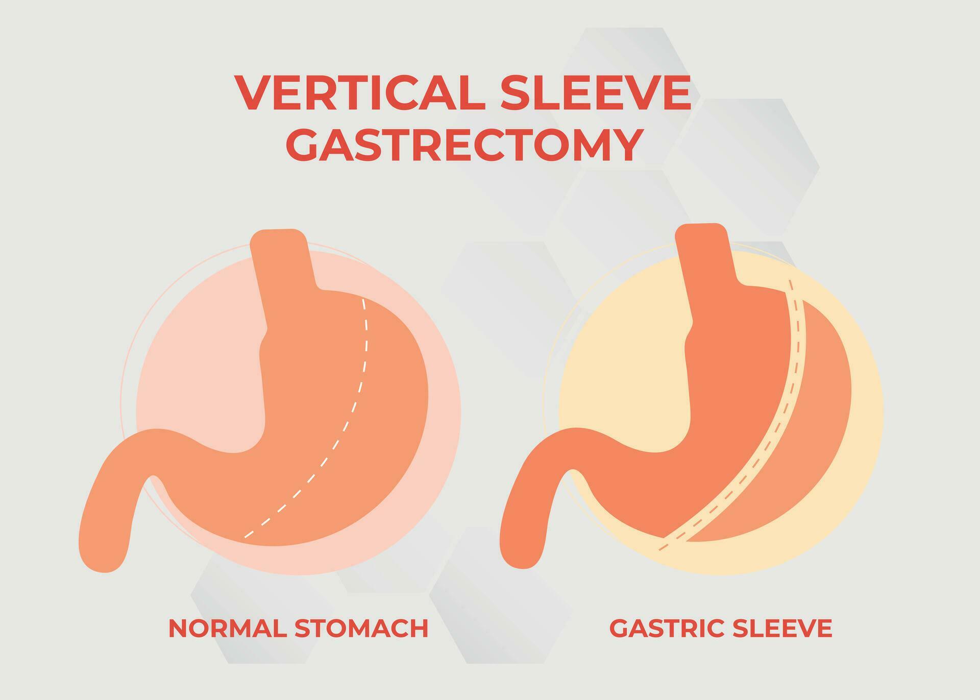 Laparoscopic Sleeve Gastrectomy, Vertical Gastrectomy, Weight loss surgery Vector Illustration