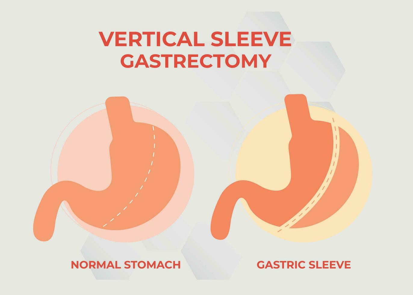 Laparoscopic Sleeve Gastrectomy, Vertical Gastrectomy, Weight loss