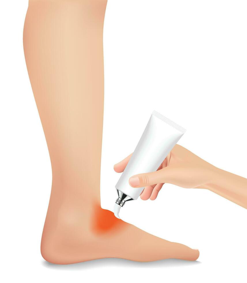 The injured foot is red and swollen like a realristic, treatment with medication. vector illustration.