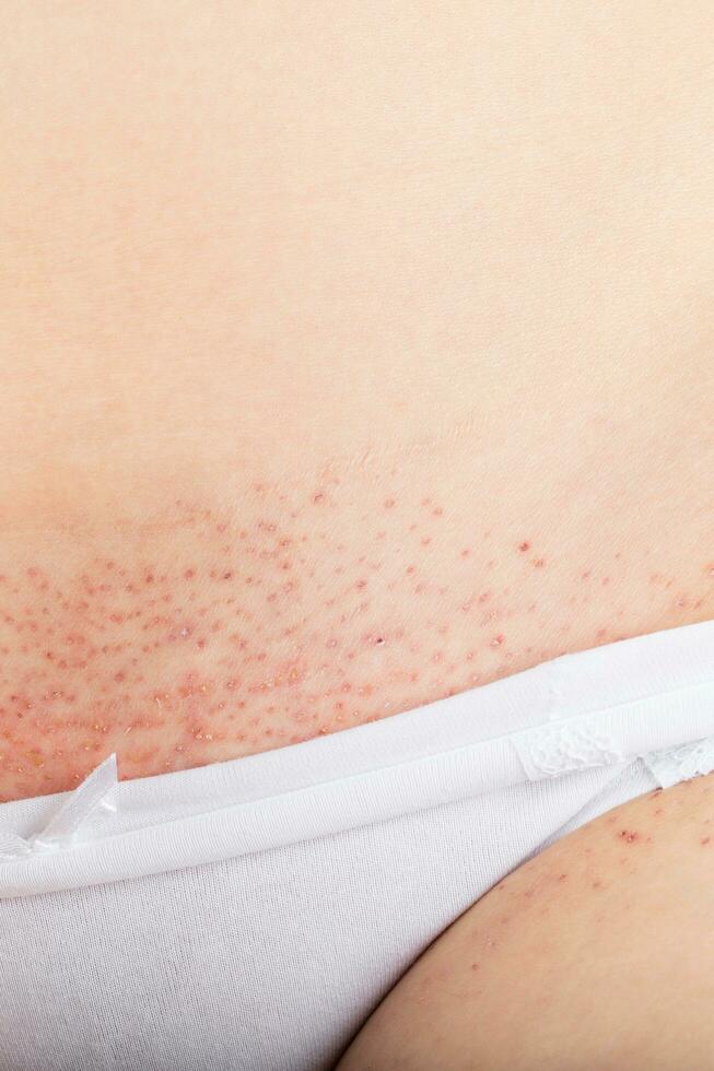 Three days after needle epilation on bikini line. photo
