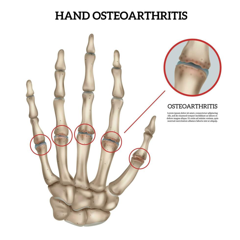 Hand Osteoarthritis Anatomy Infographic vector