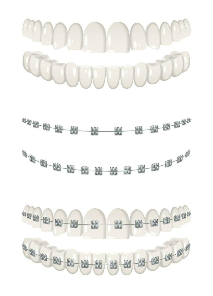 Teeth Braces Set vector