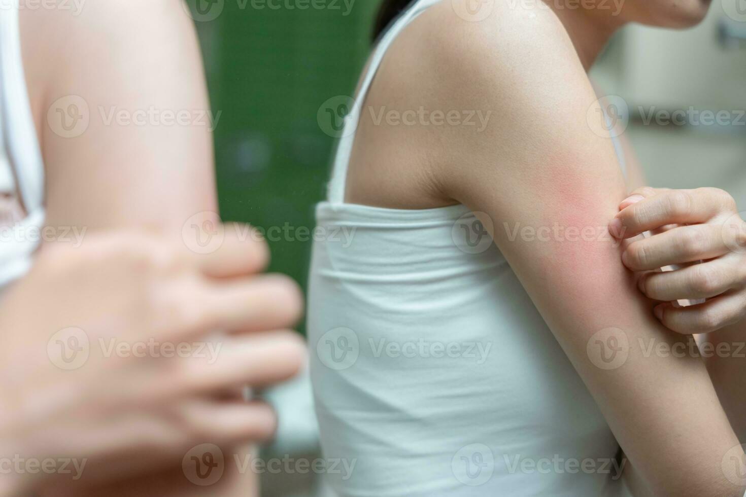 skin problem and beauty. Young woman scratch body has itchy skin from skin allergic, steroid allergy, sensitive skin, red from sunburn, chemical allergy, rash, insect bites, Seborrheic Dermatitis. photo