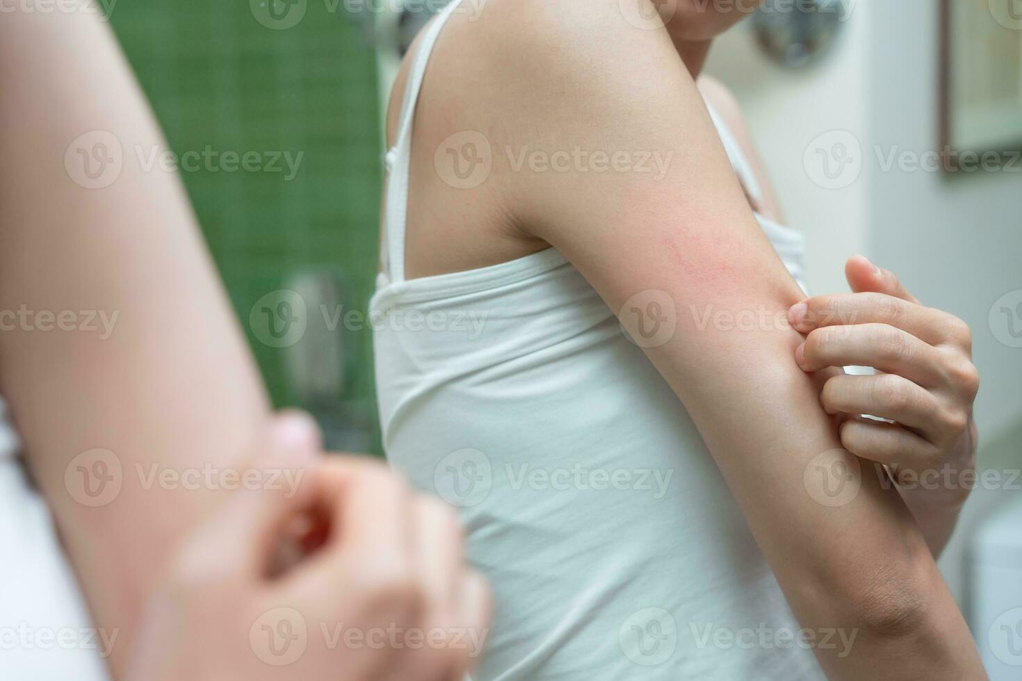 skin problem and beauty. Young woman scratch body has itchy skin from skin allergic, steroid allergy, sensitive skin, red from sunburn, chemical allergy, rash, insect bites, Seborrheic Dermatitis. photo