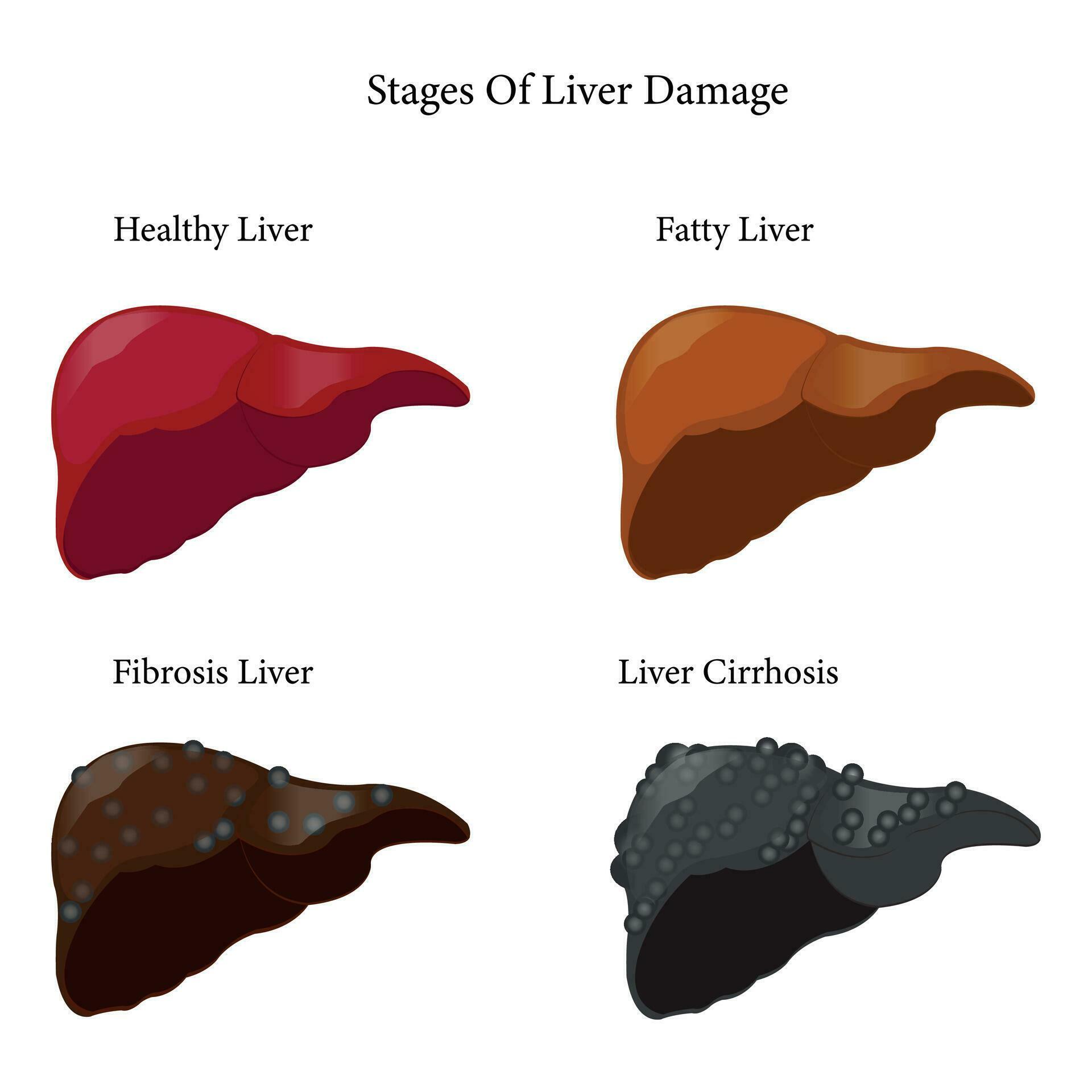 Stages of liver damage. Healthy, fatty, liver fibrosis and cirrhosis