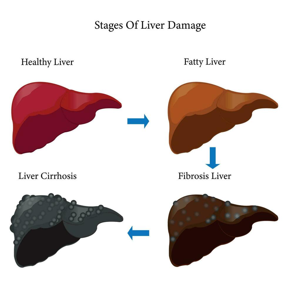 Stages of liver damage. Healthy, fatty, liver fibrosis and cirrhosis. isolated on white background. eps 10 vector