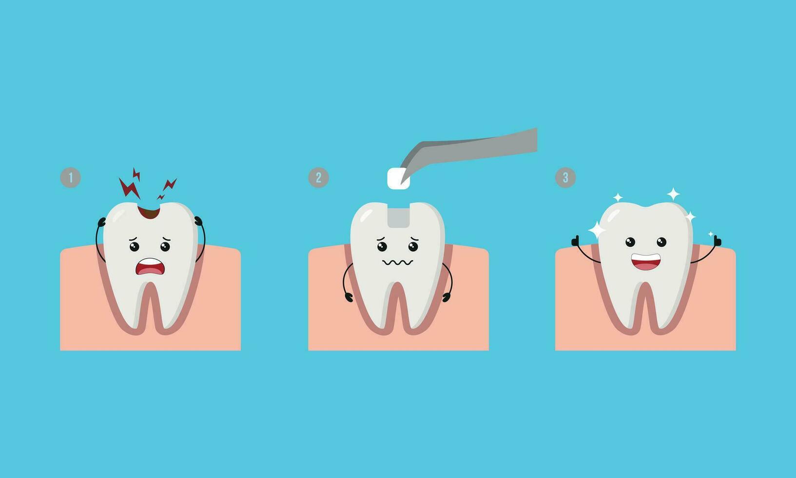 dental paso de restaurar cavidad diente por relleno diente ilustración dibujos animados personaje vector diseño en azul antecedentes. dental cuidado concepto.