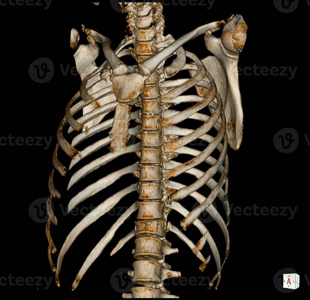 X-ray and CT Scan thoracic spine photo