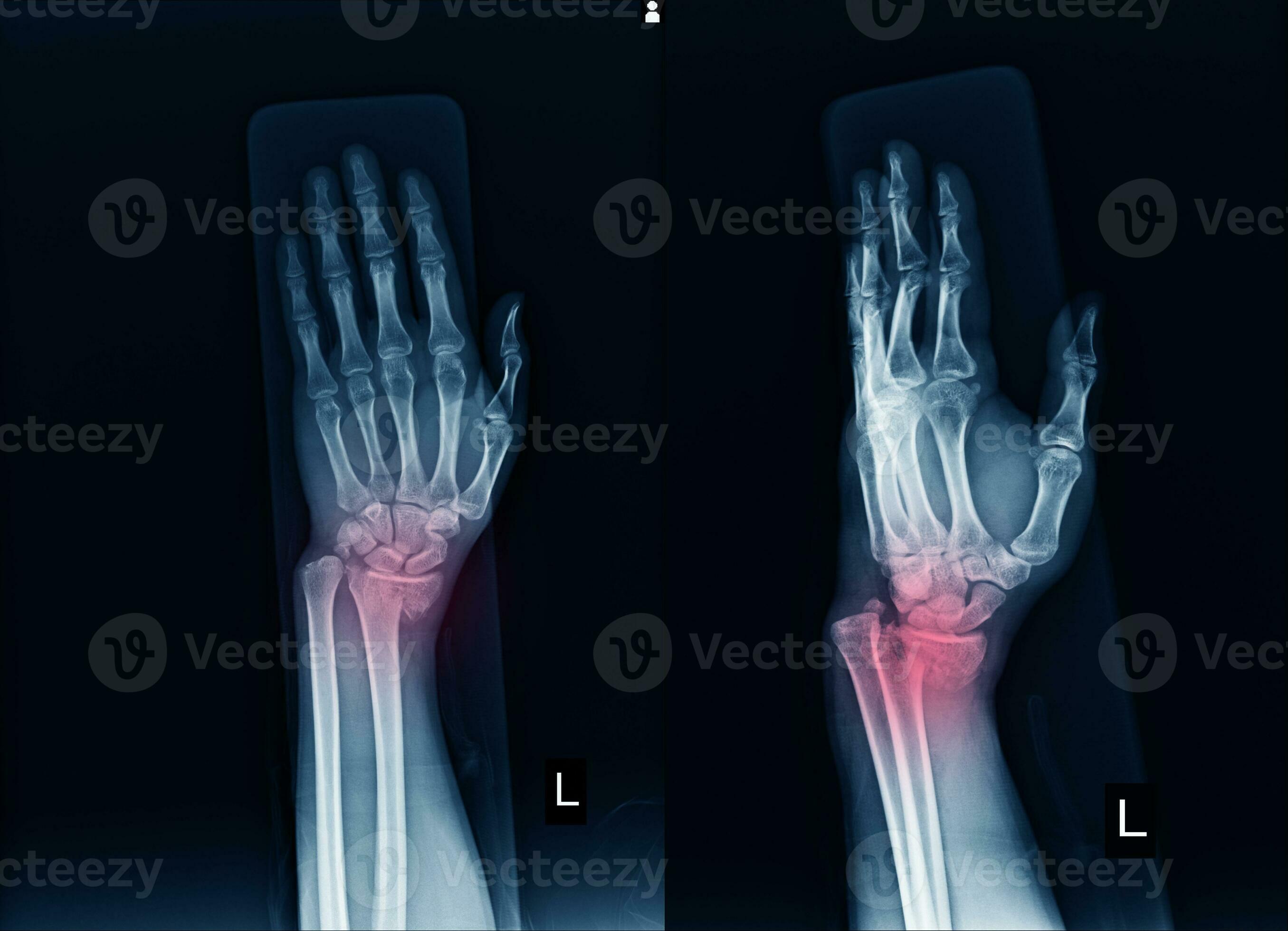 Xray Left wrist joint Fracture with displacement distal end left