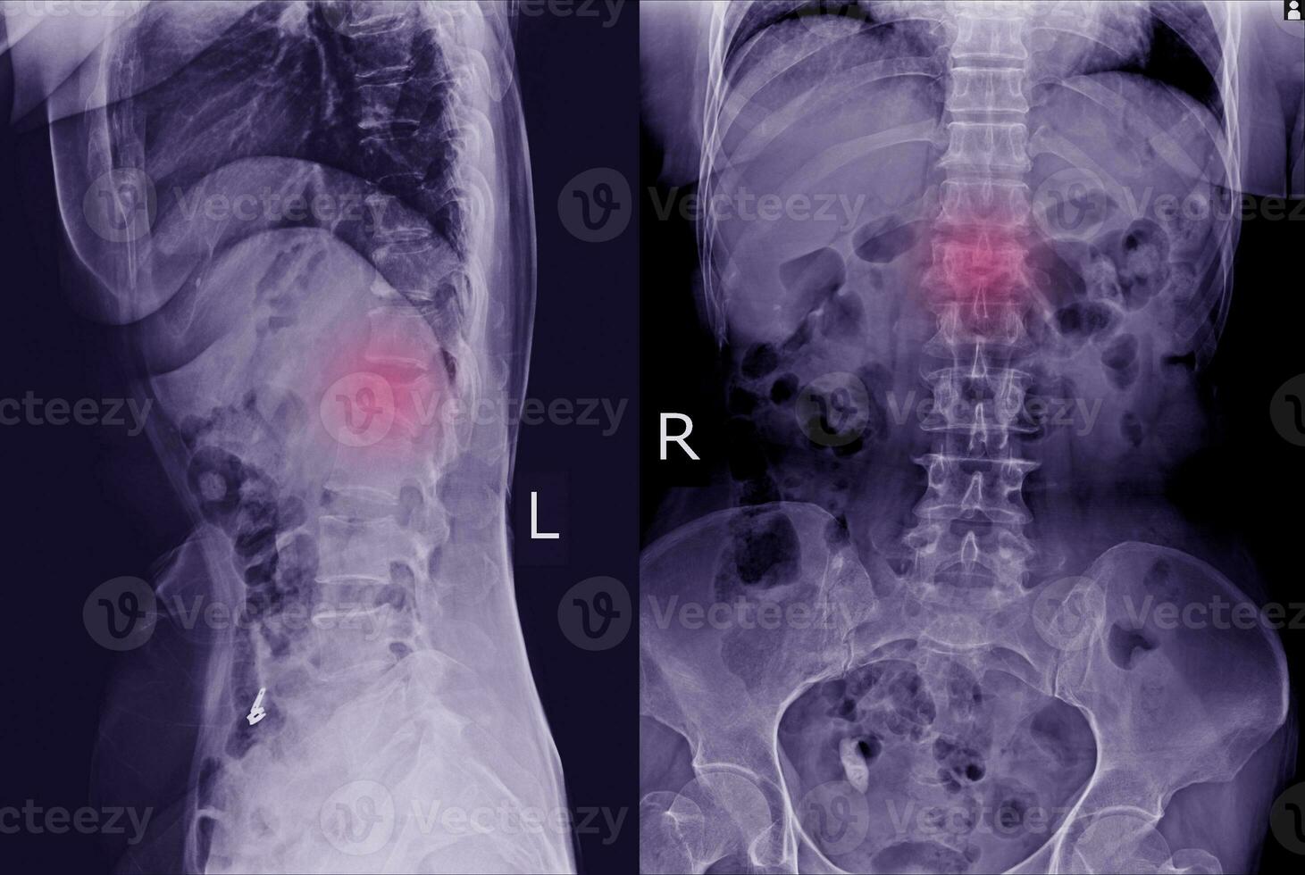 X-ray L-S Spine AP LATERAL Finding Moderate compression fracture of L1 vertebra. photo