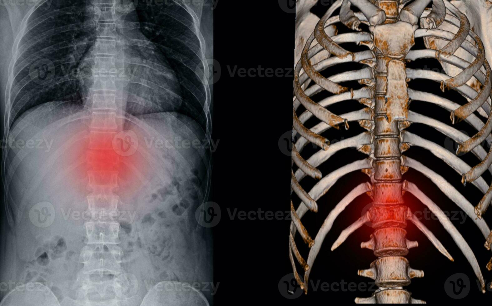 X-ray and CT Scan thoracic spine fracture. photo