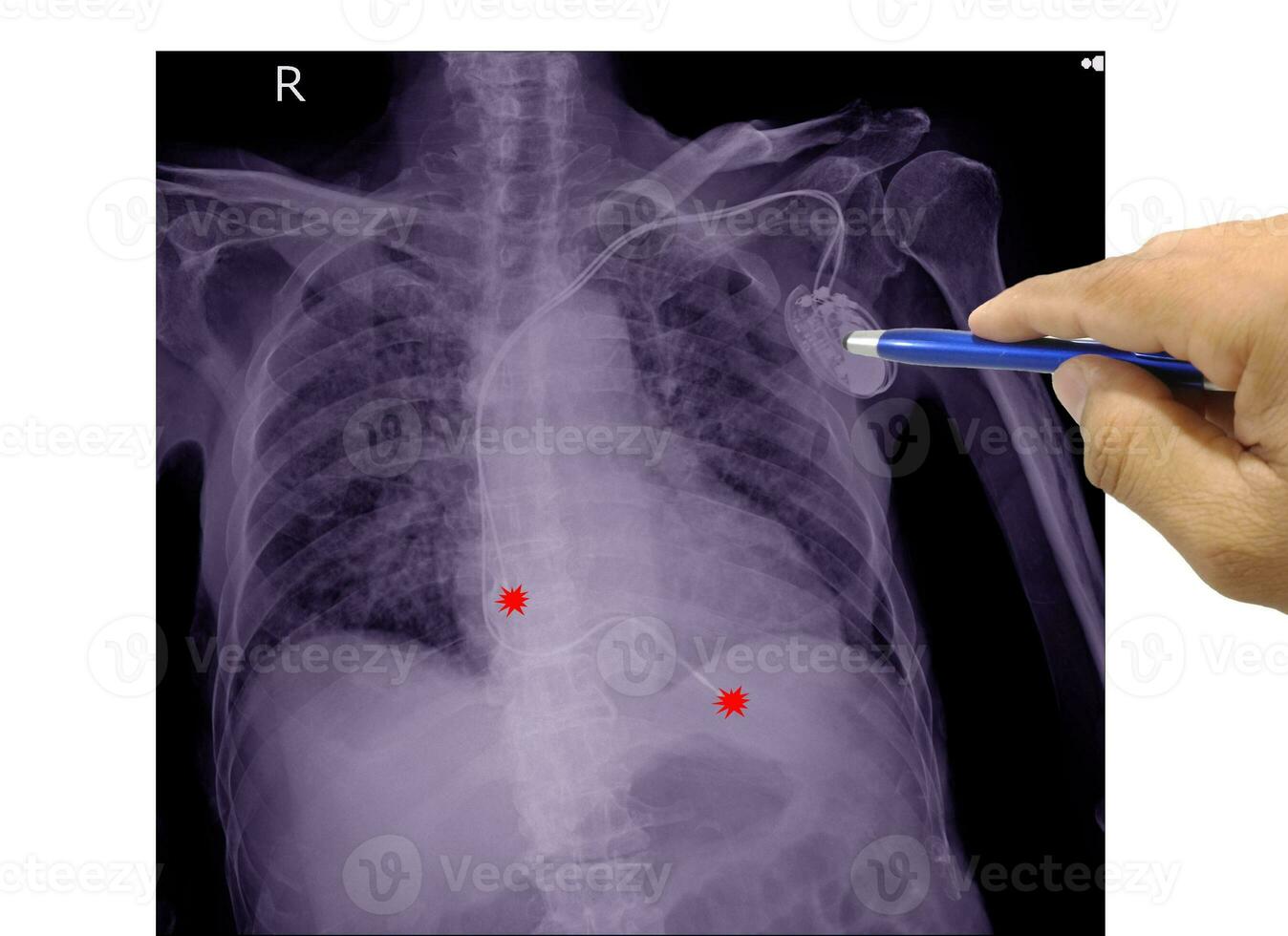 Chest x-ray film of a patient with permanent pacemaker implant in chest body photo