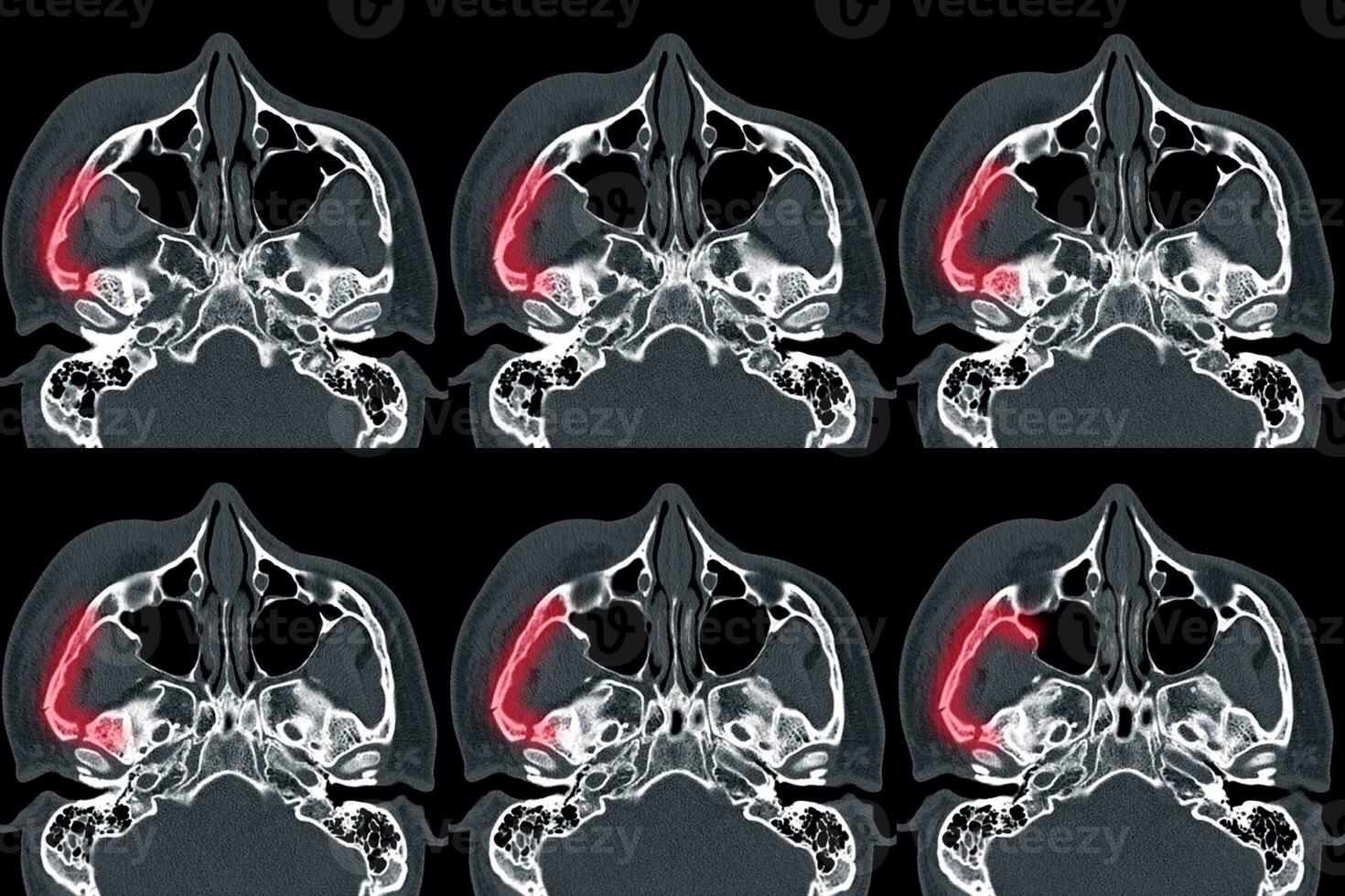 Computed tomography of Orbit Displaced fracture at lateral and medial wall of right orbit. photo