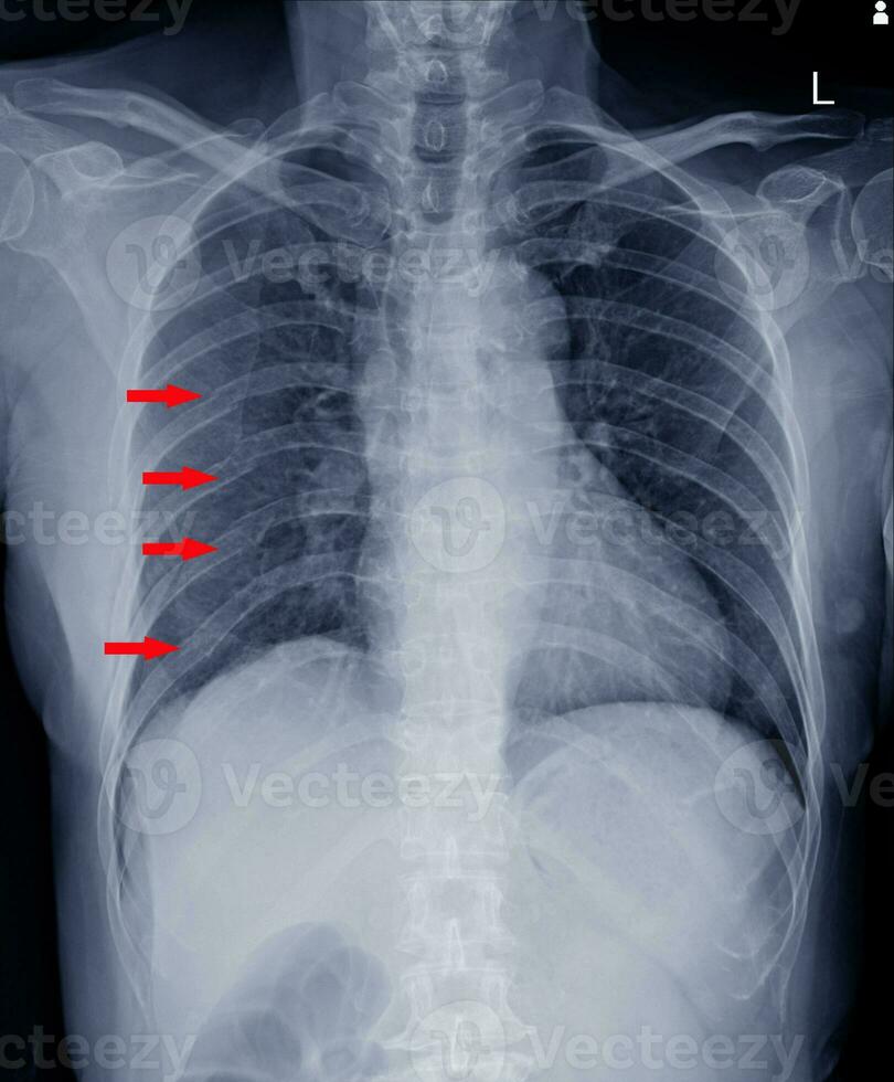 Multiple  fracture ribs x-ray chest. photo