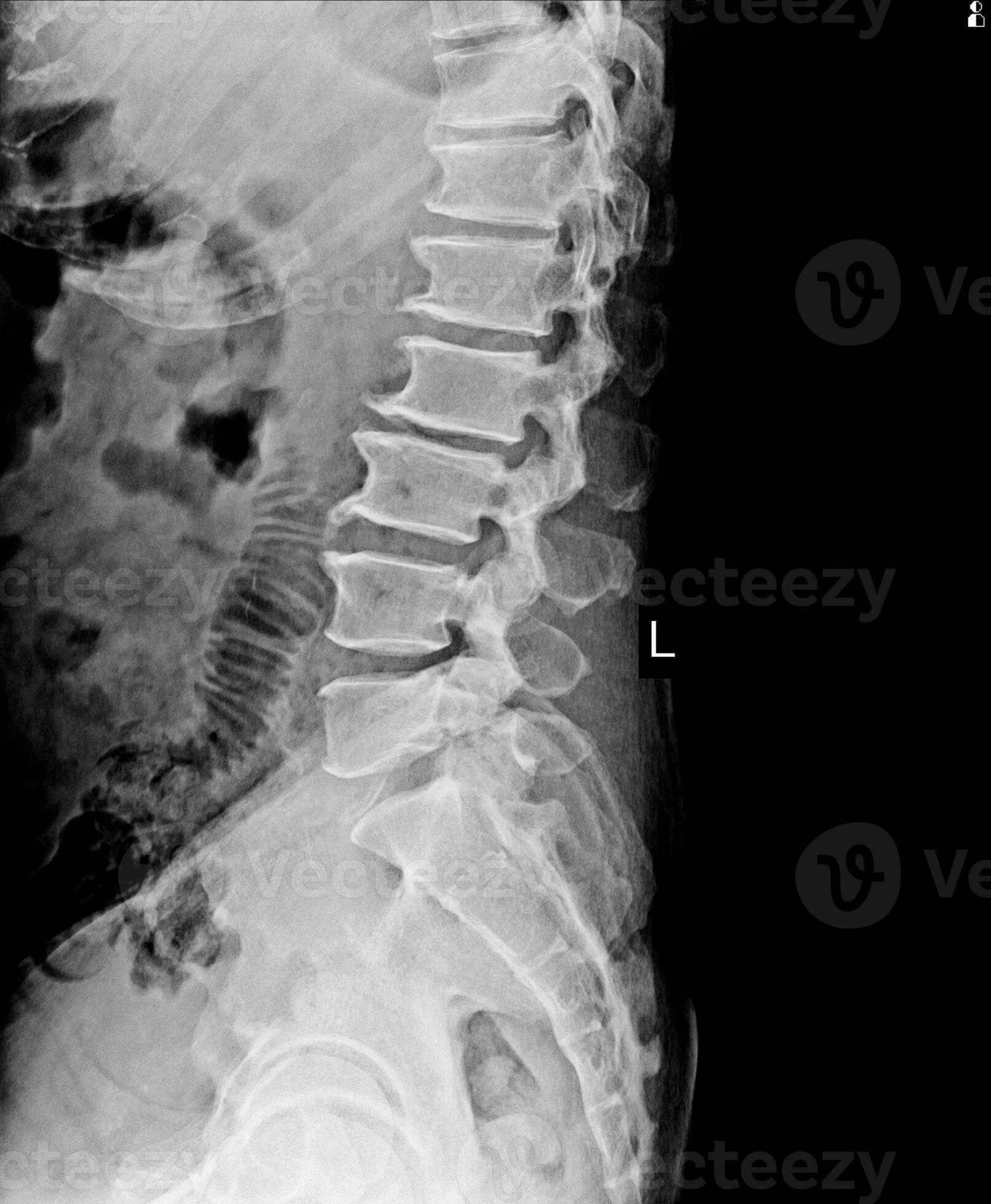 Lumbar spine xray show spur of vertebral body. 26434009 Stock Photo at
