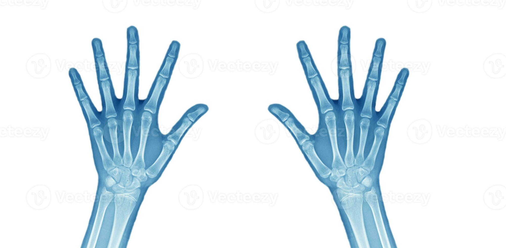 x-ray both hands on white background Medical image concept. photo