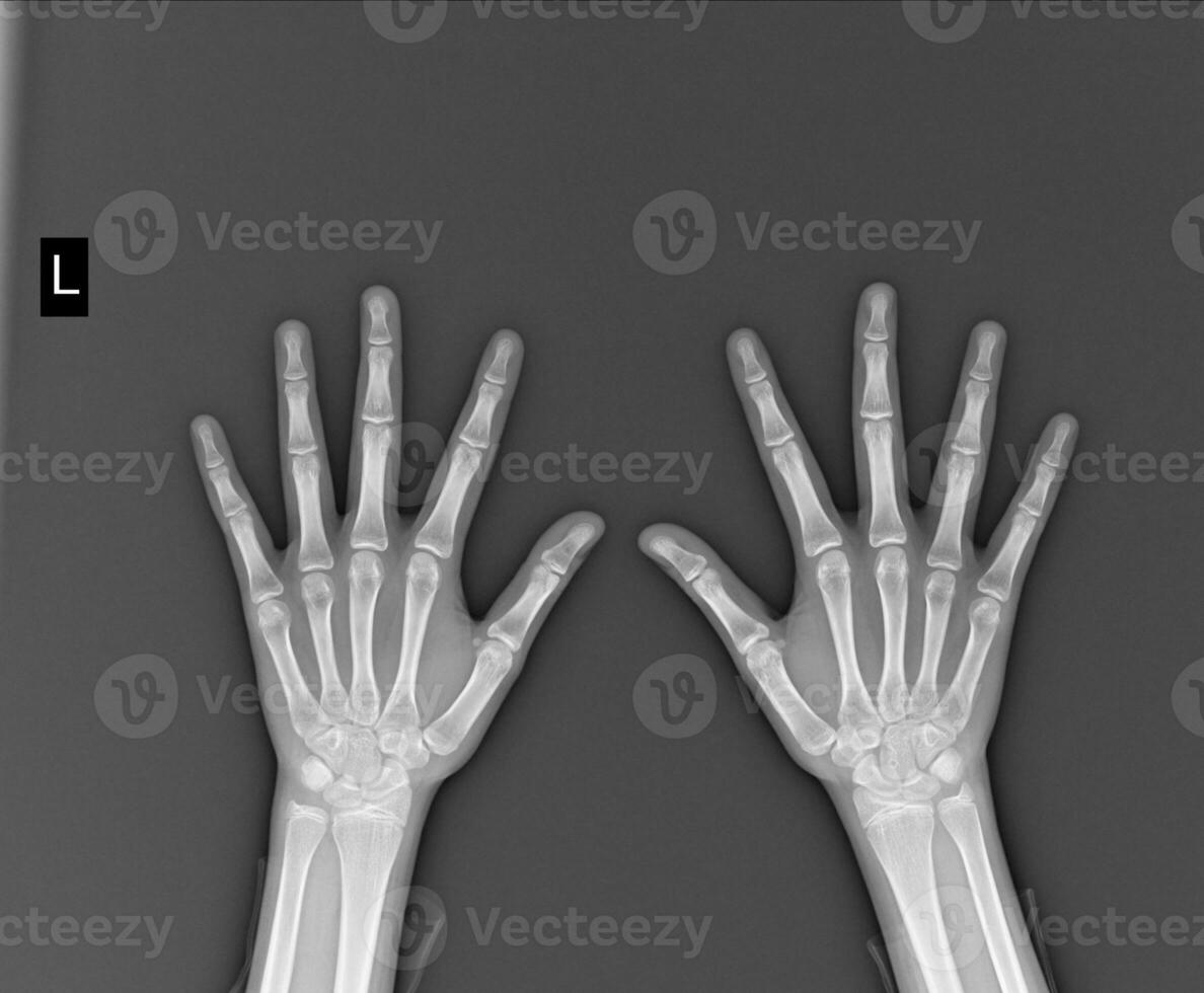 x-ray both hands on white background Medical image concept. photo