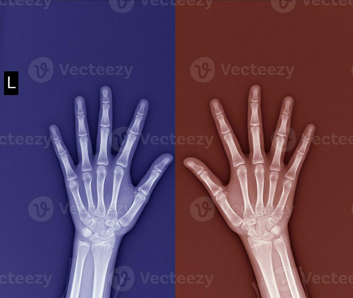 film x-ray both hand AP  show normal human hands on black background photo