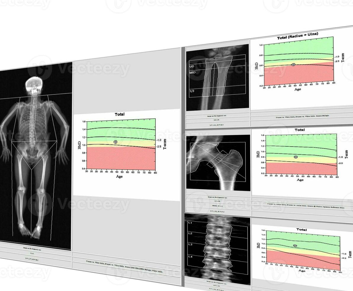 special examination medical image bone density. photo