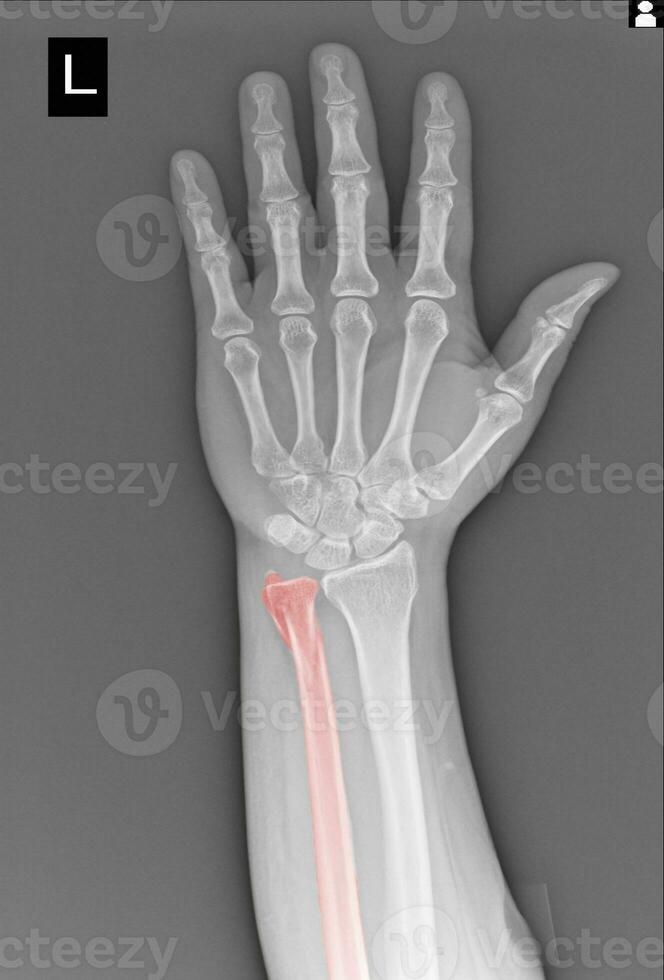 x-ray hands and wrist on white background Medical image concept. photo