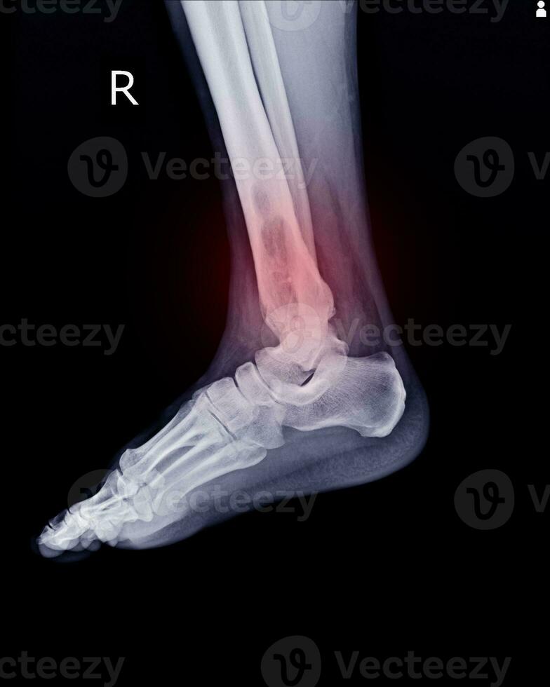 radiografía rt.tobillo hallazgo intramedular osteolítico lesión de Derecha distal tibia foto