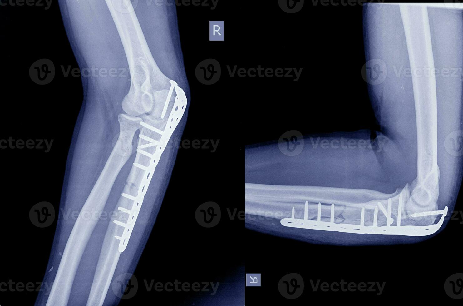 Elbow An olecranon fracture my be held together with plate and screws. photo