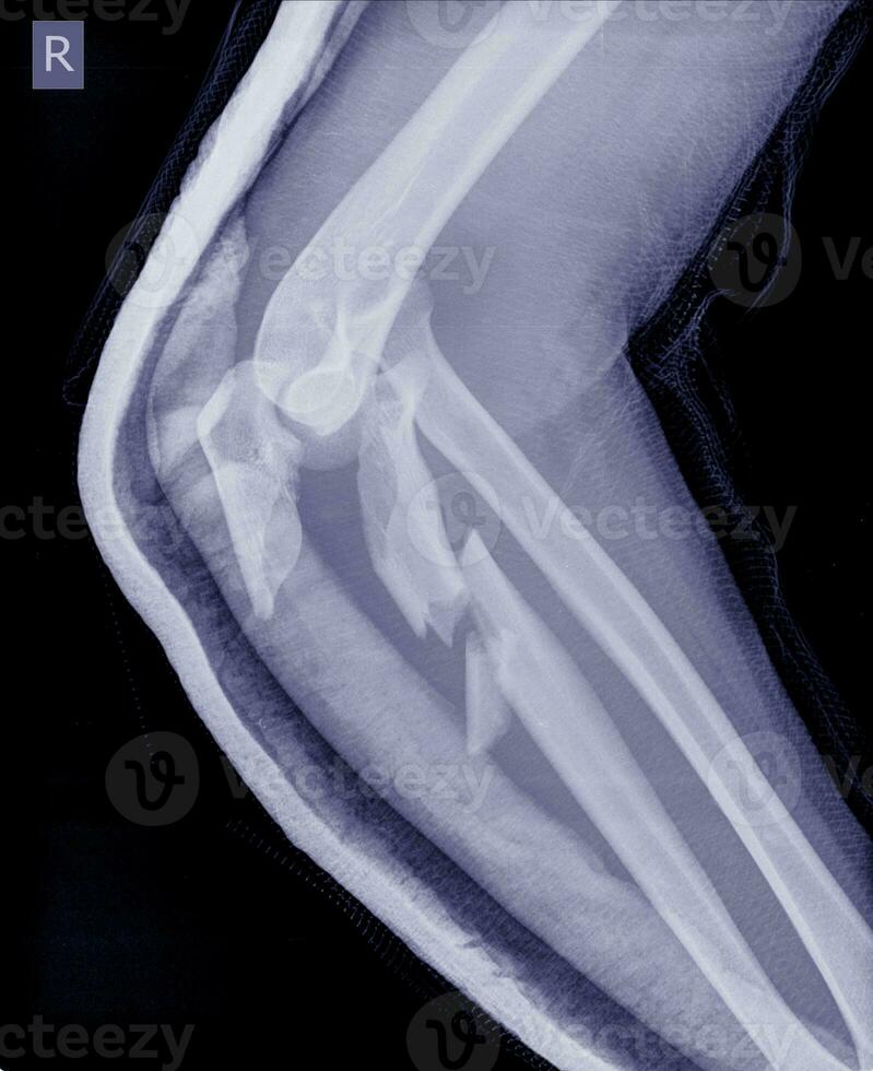 Elbow An olecranon fracture my be held together with plate and screws. photo