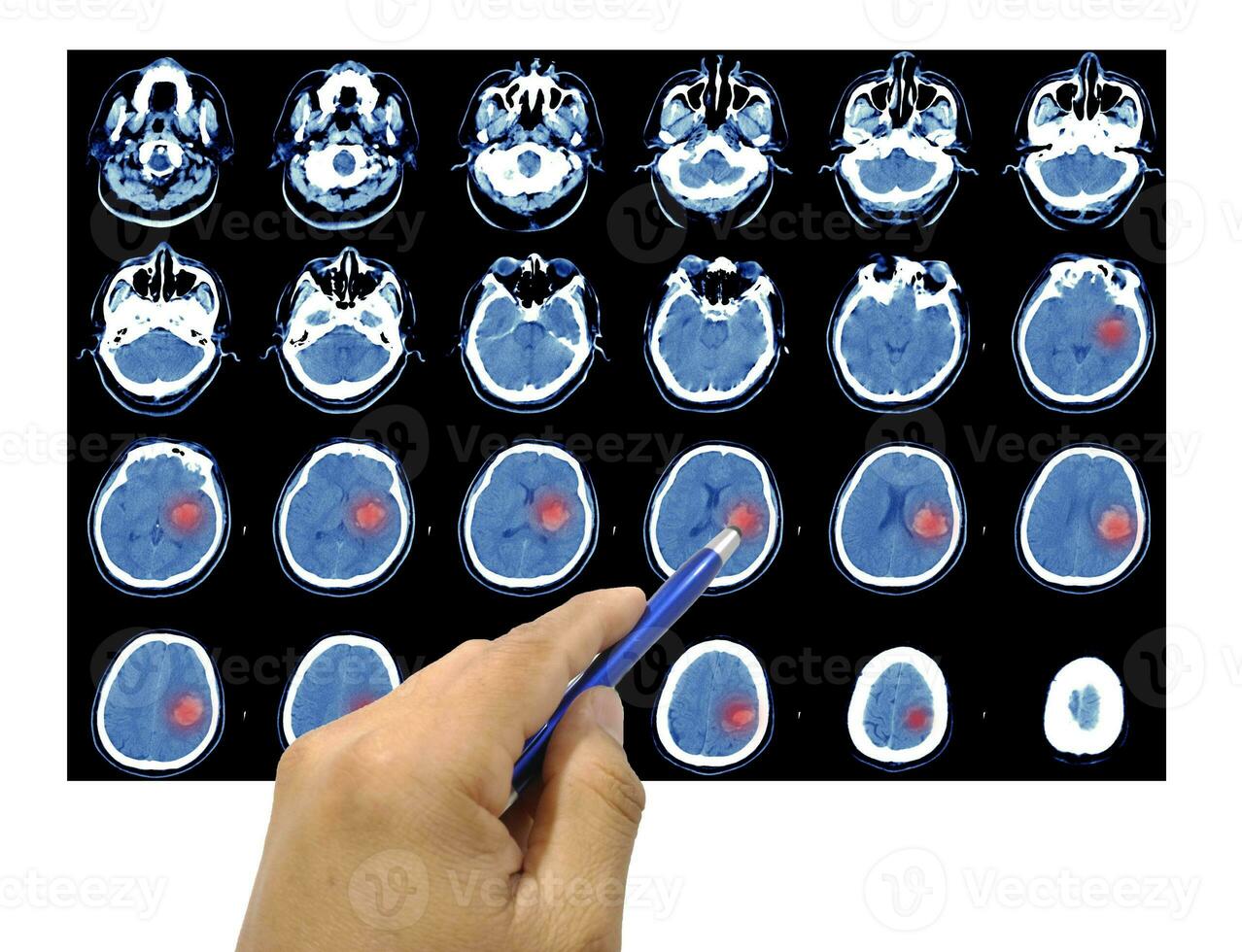 Close up hand Doctor point CT SCAN OF THE NECK HISTORY A69-year-old male presented with Computed tomography of the brain left thalamic hemorrhage photo