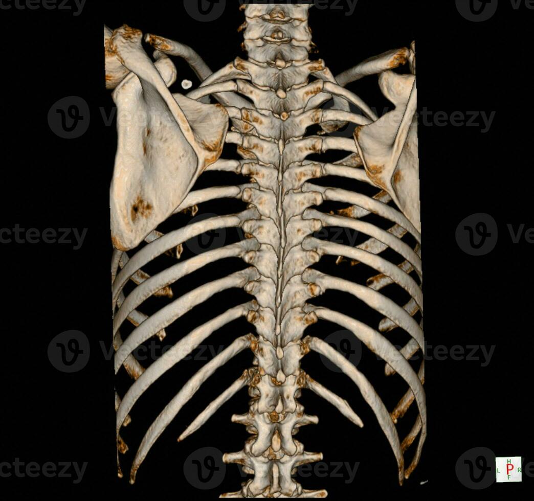 X-ray and CT Scan thoracic spine photo