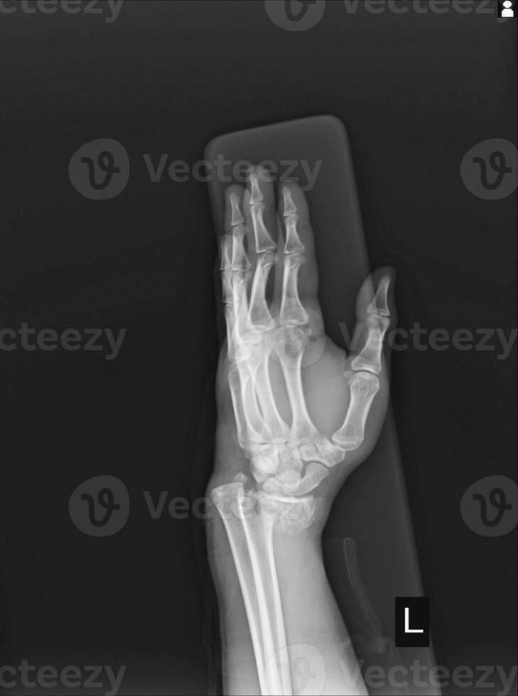 X-ray Left wrist joint Fracture with displacement distal end left radius. photo