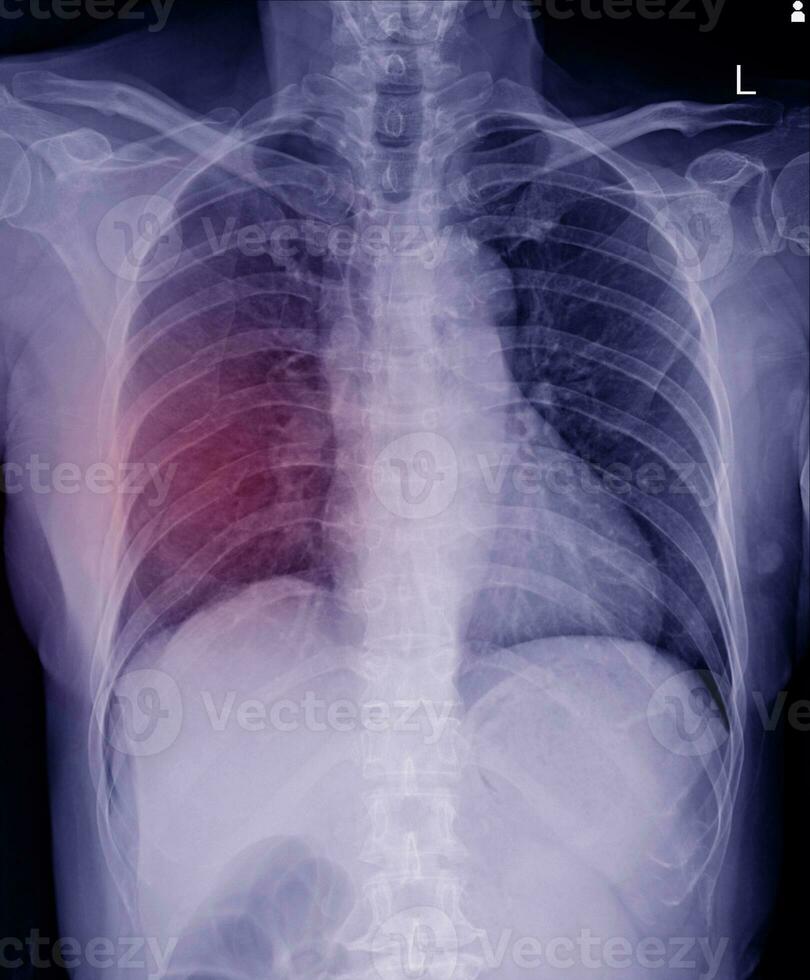 Multiple  fracture ribs x-ray chest. photo