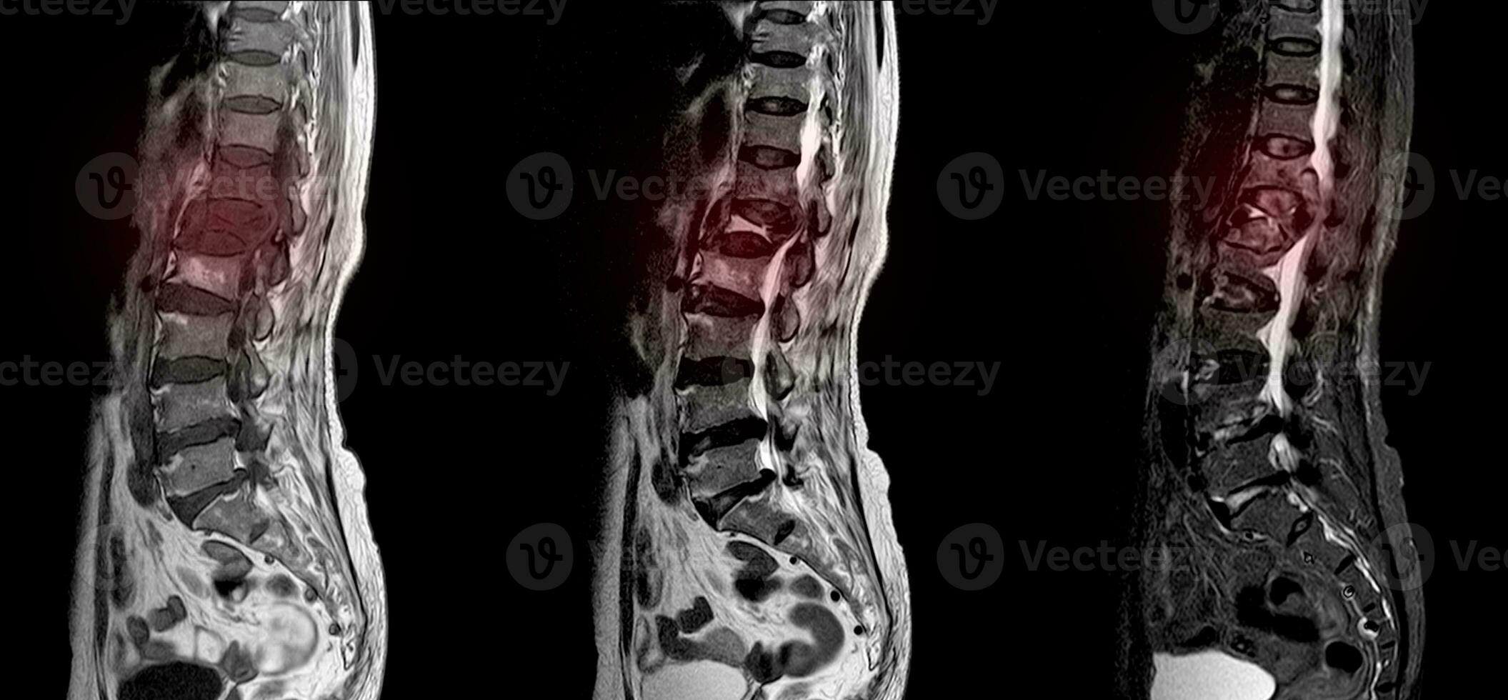 mri de el lumbosacro columna vertebral. foto