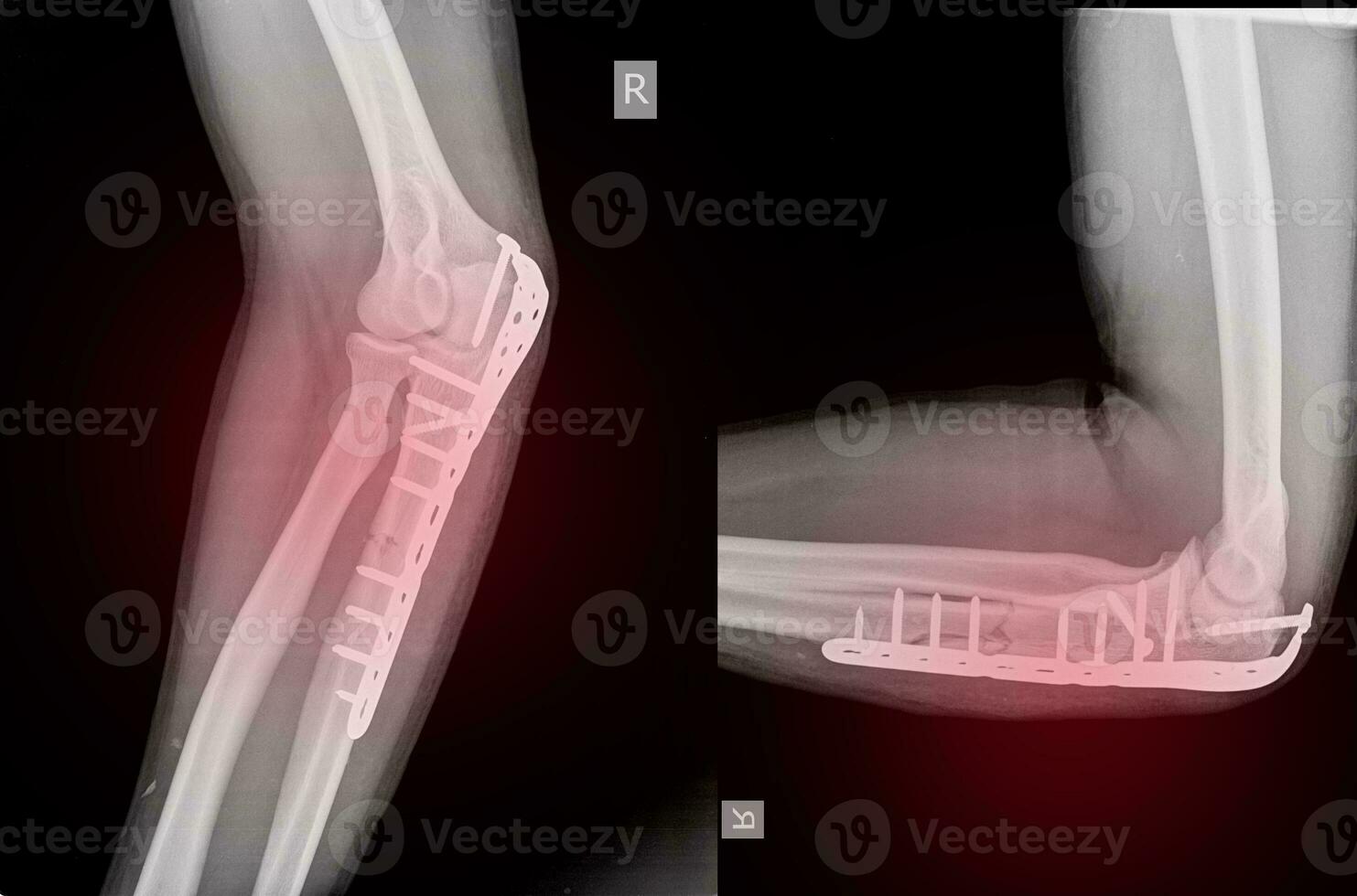 Elbow An olecranon fracture my be held together with plate and screws. photo