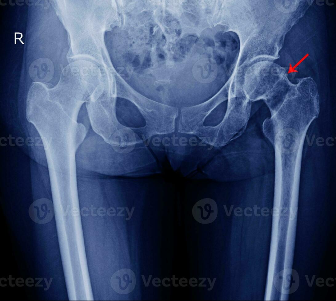 x-ray both hip photo