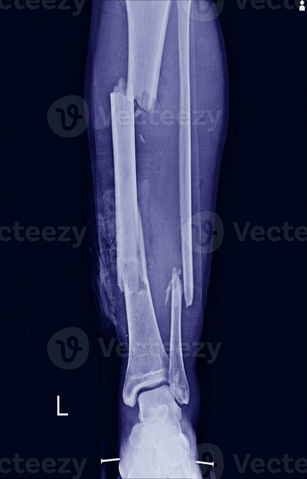 Film xray Multiple fracture leg tibia and fibular photo