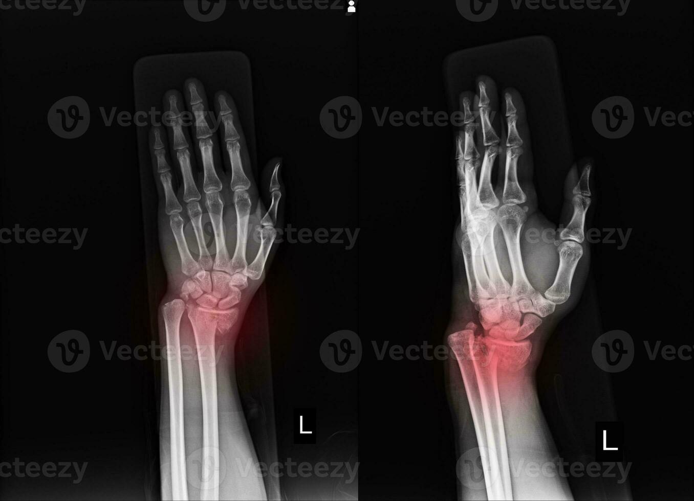 X-ray Left wrist joint Fracture with displacement distal end left radius. photo