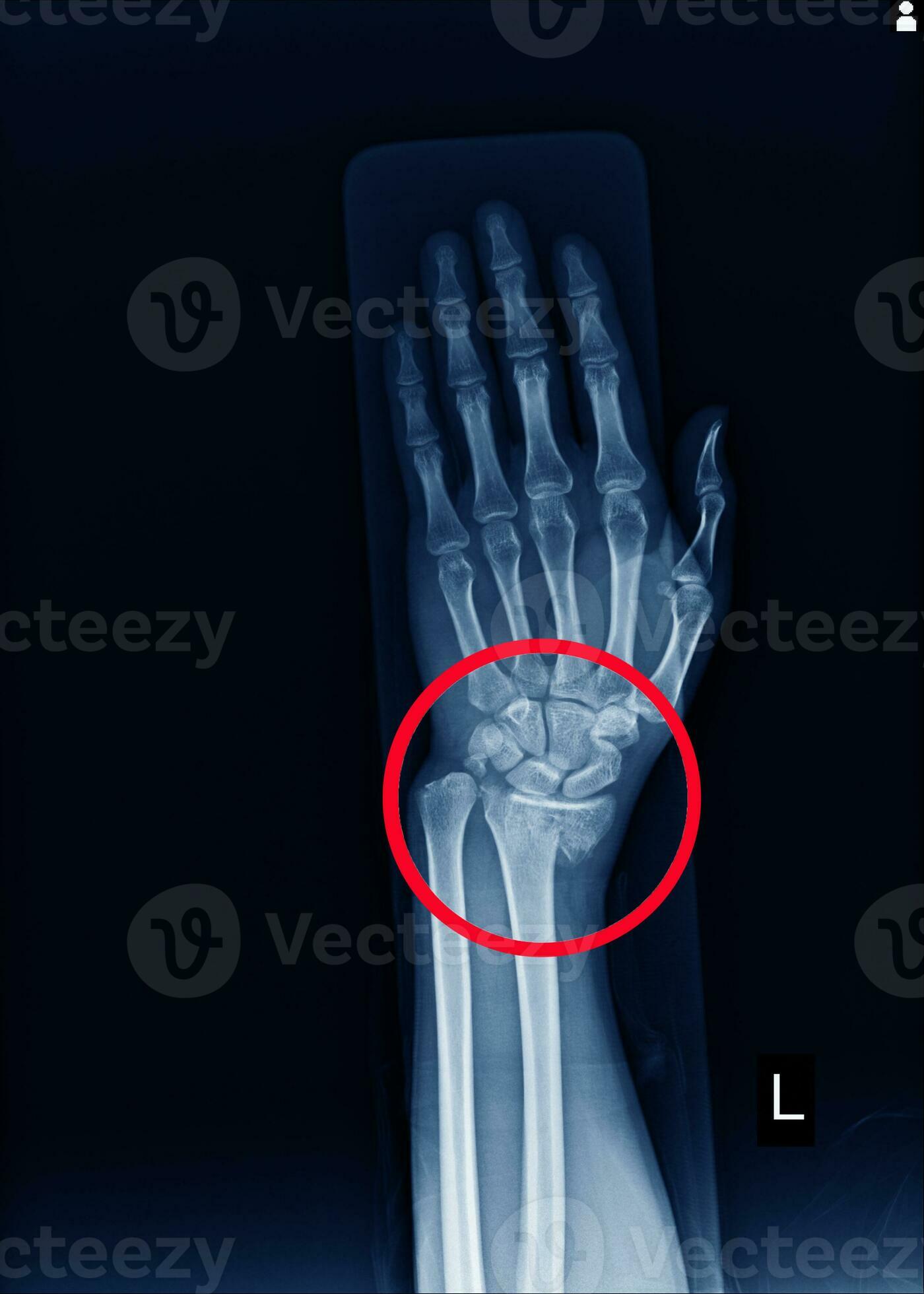 Xray Left wrist joint Fracture with displacement distal end left