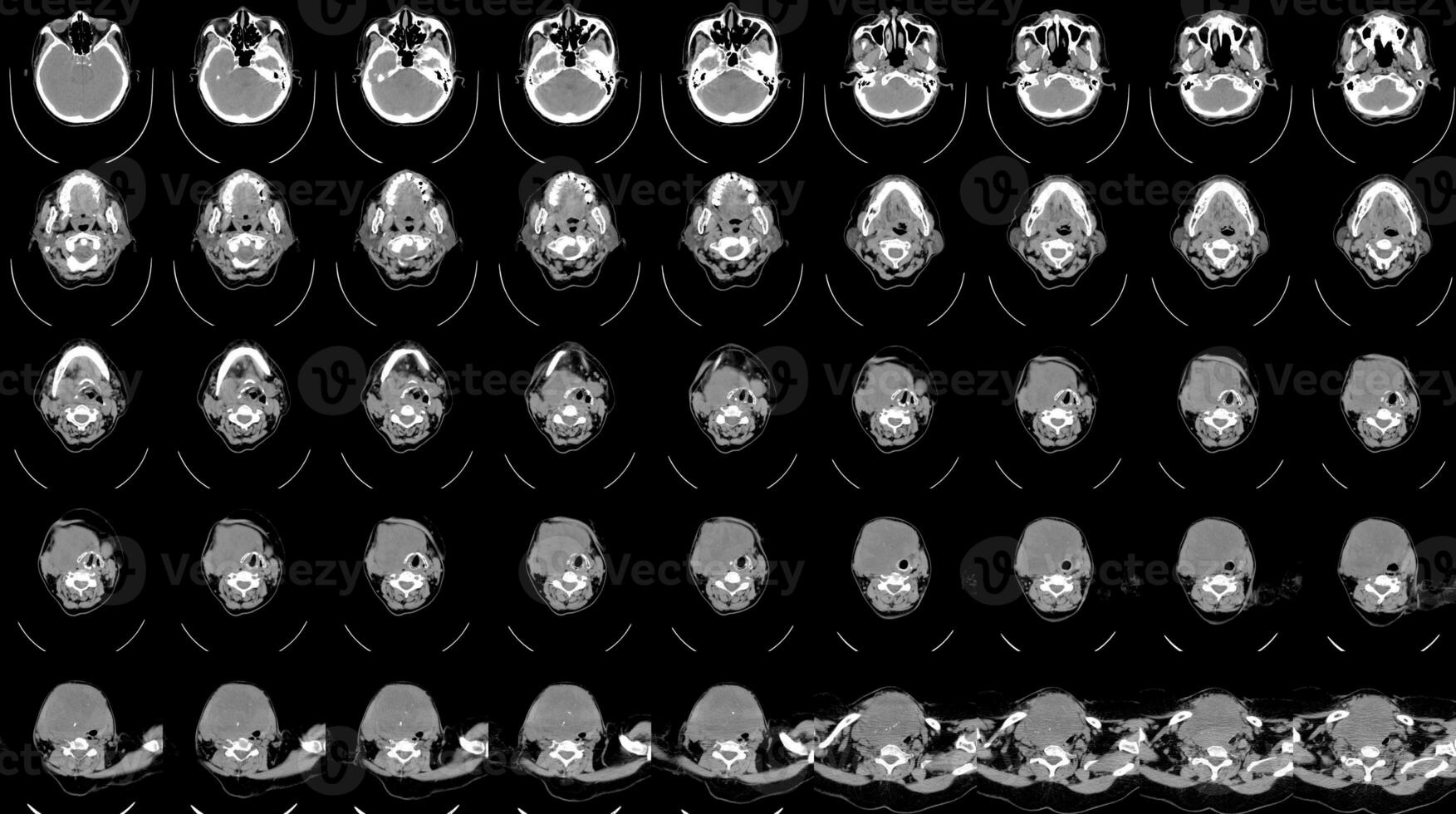 CT SCAN OF THE NECK HISTORY A69-year-old female presented with neck mass and right TVC paralysis. photo