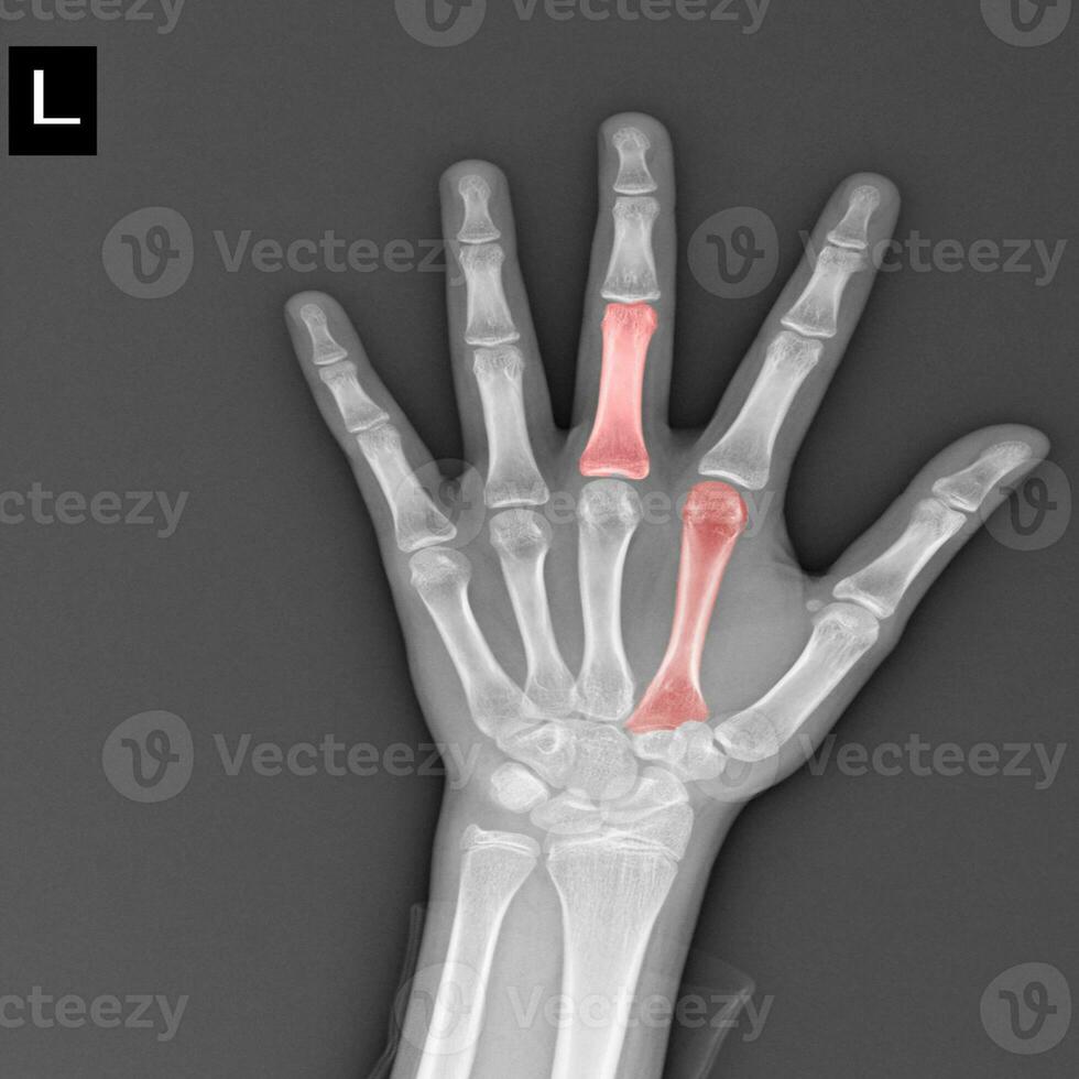 x-ray both hands on white background Medical image concept. photo