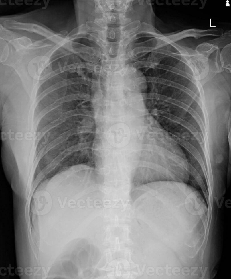 Multiple  fracture ribs x-ray chest. photo