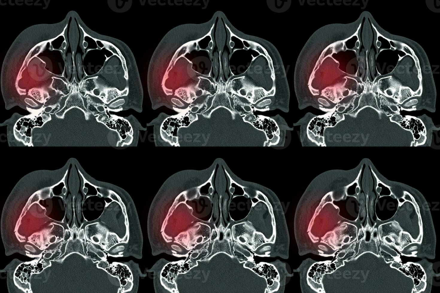 Computed tomography of Orbit Displaced fracture at lateral and medial wall of right orbit. photo