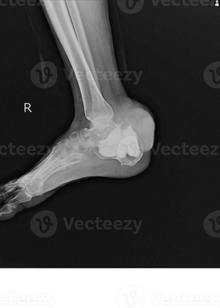 lateral Derecha pie radiografía demostración destrucción de el posteroinferior aspecto de el calcáneo. foto