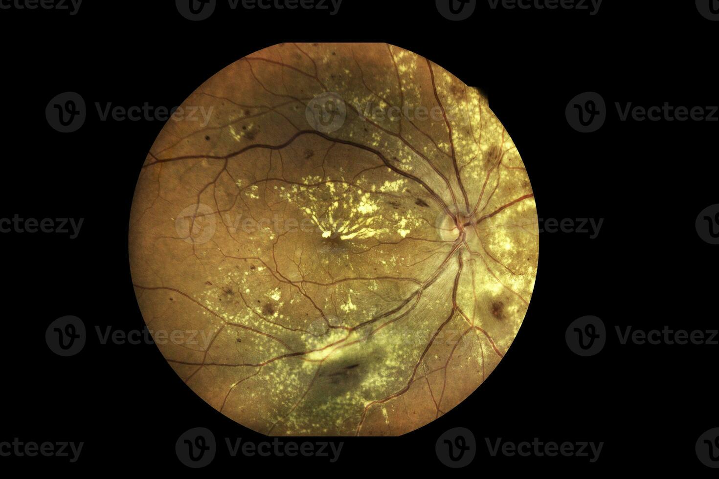 View inside human eye disorders showing retina, optic nerve and macula Severe age-related macular degeneration photo