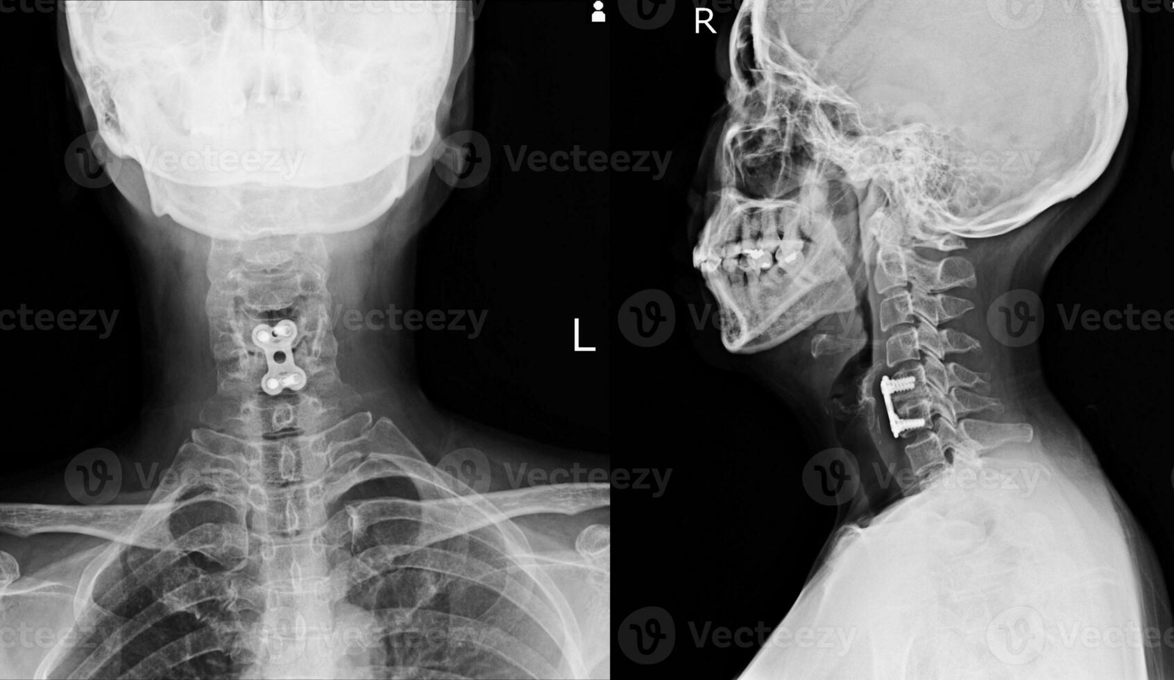 C-Spine x-ray spinal fication of C5-6 bodies  No spinal dislocation photo